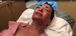 MicroNeedling with PRP Demonstration