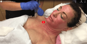 MicroNeedling with PRP - Skin Care