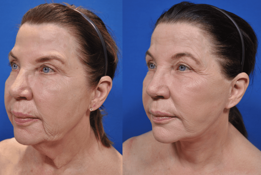 Learning The Difference Between Skin Tightening and Soft Lift: Rejuvenate  with Pacific Derm - Pacific Derm