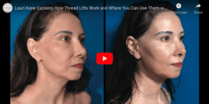 lauri explains how threadlifts work and where to use them