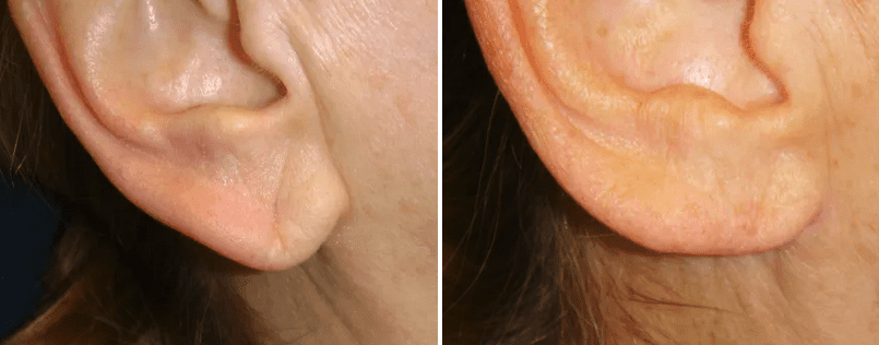 Lauri Kane Discusses Filler for the Earlobes