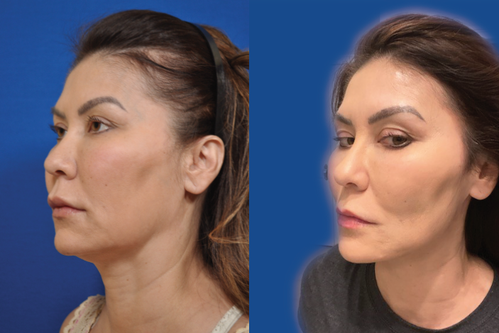 PDO THREADS - New York Facial & Body Rejuvenation