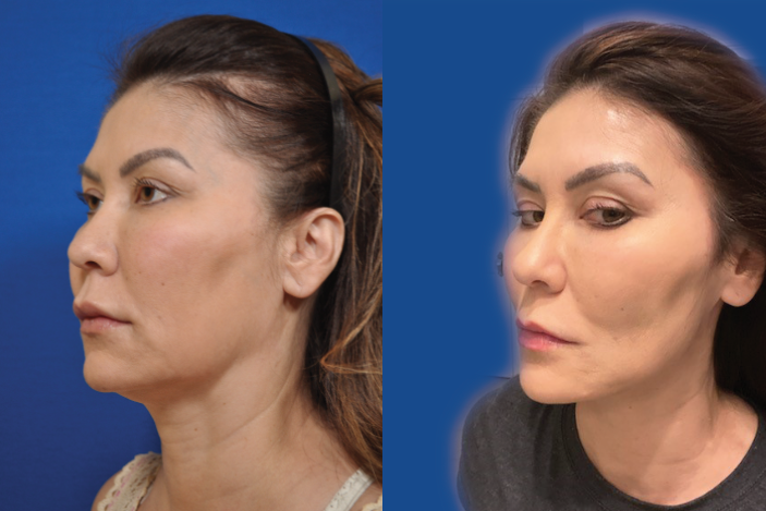 PDO Threads  Non-invasive Facelift Treatment in Brooklyn NY