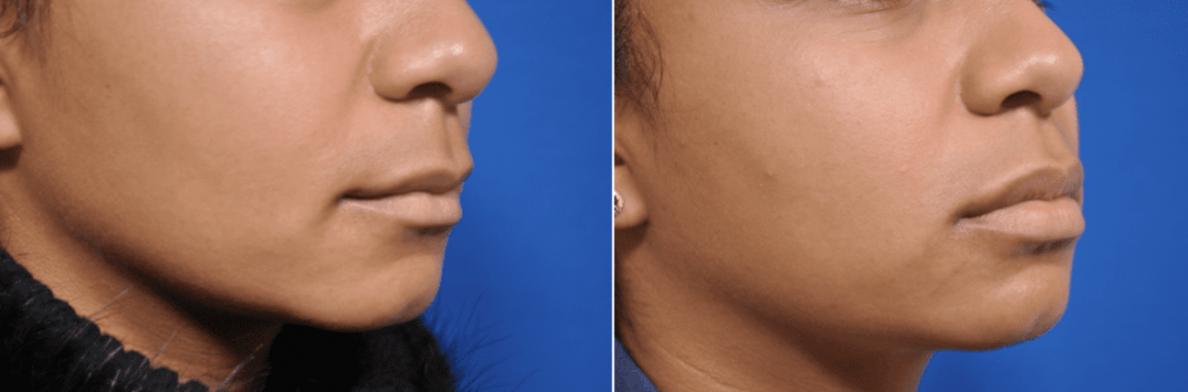 The Art of Nose Slimming with Muscle Relaxants: A Non-Surgical